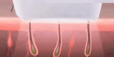Safe & Effective IPL Permanent Laser Hair Removal Device for Face and Body for Men & Women